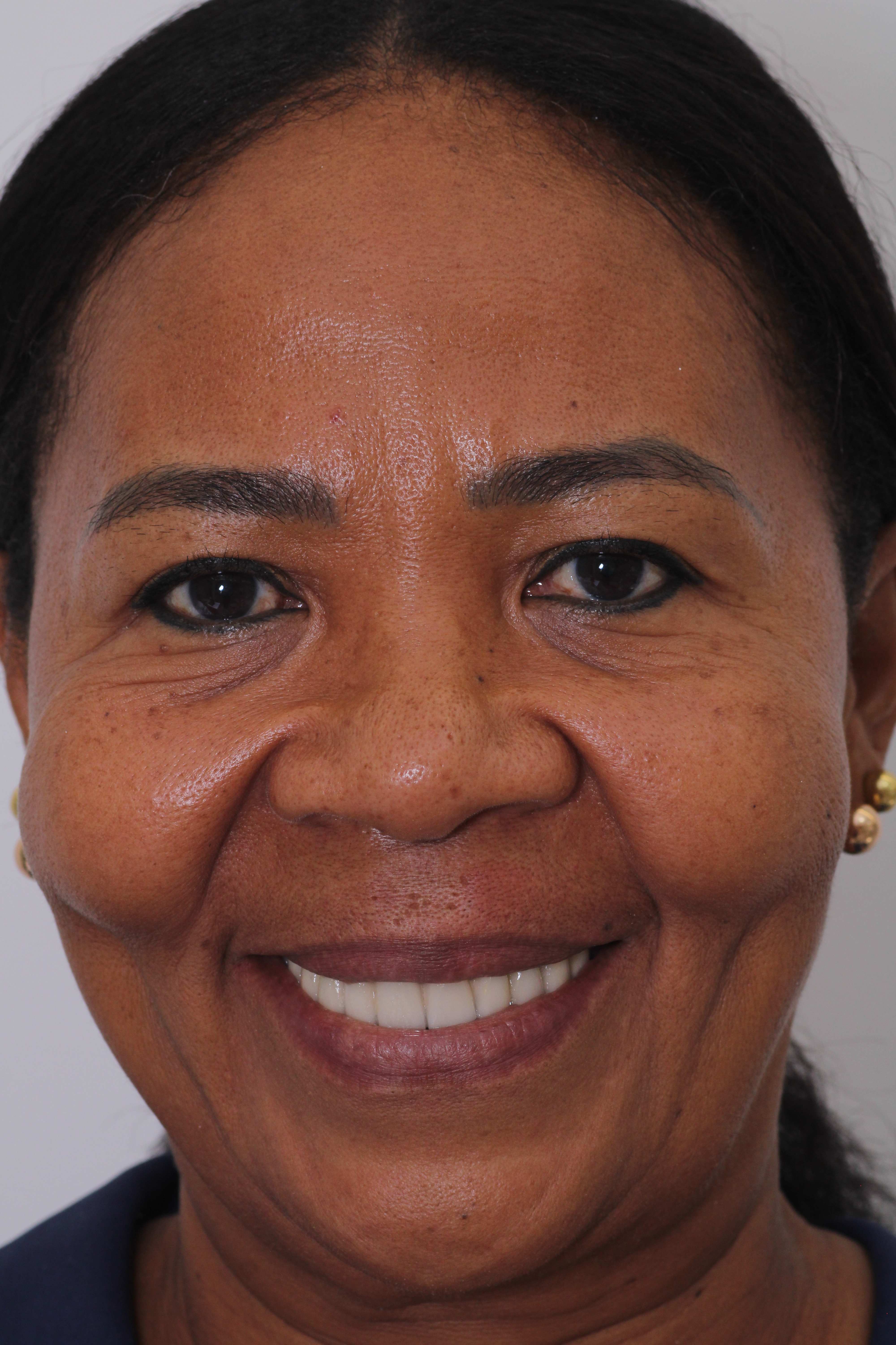 Paciente feliz mostrando su sonrisa natural después del tratamiento con implantes dentales