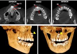Tomografía 3D para planificación de implantes dentales