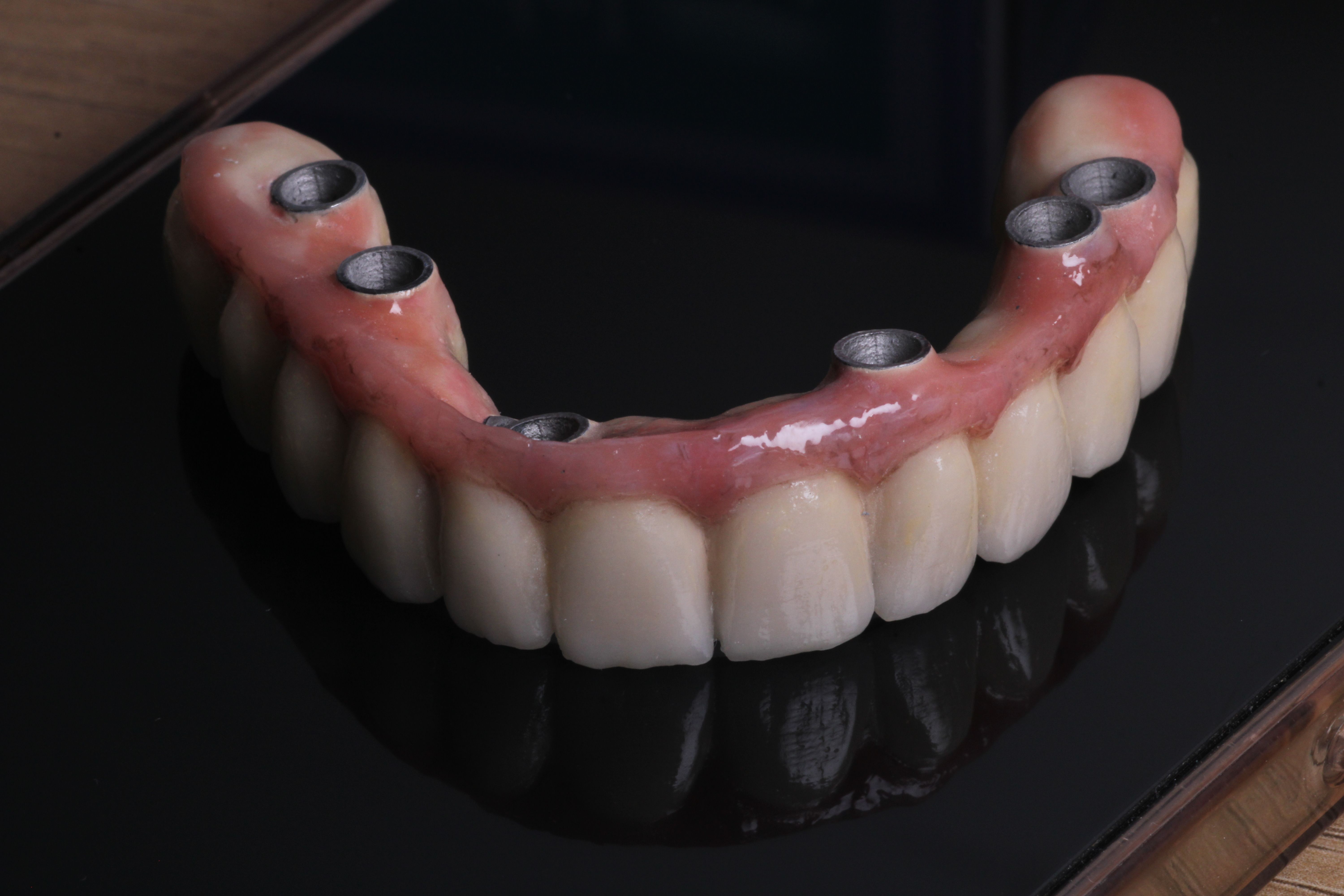 Prótesis dental sobre implantes vista superior mostrando los conectores de titanio