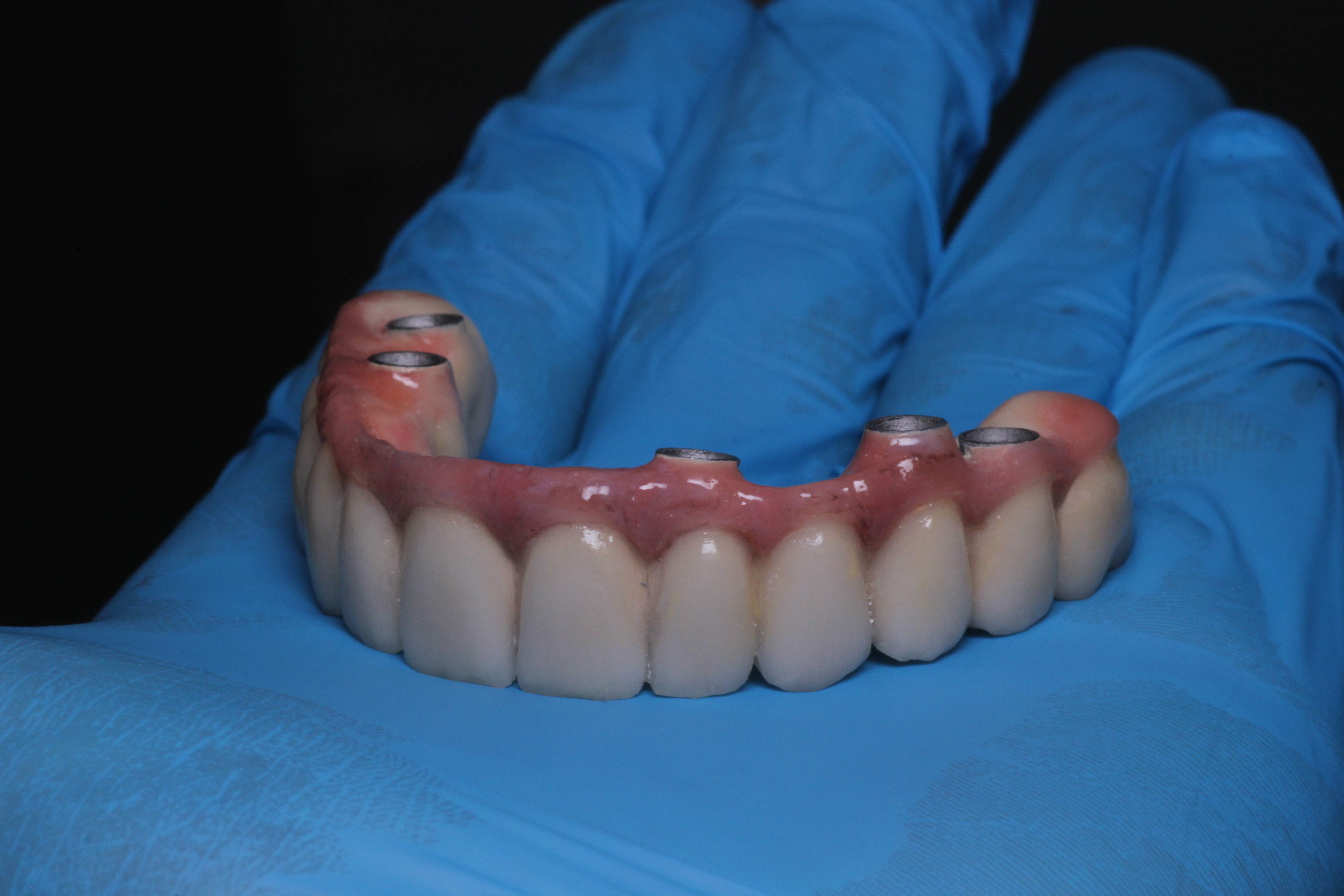 Prótesis dental sobre implantes sostenida por el especialista, mostrando la calidad del trabajo