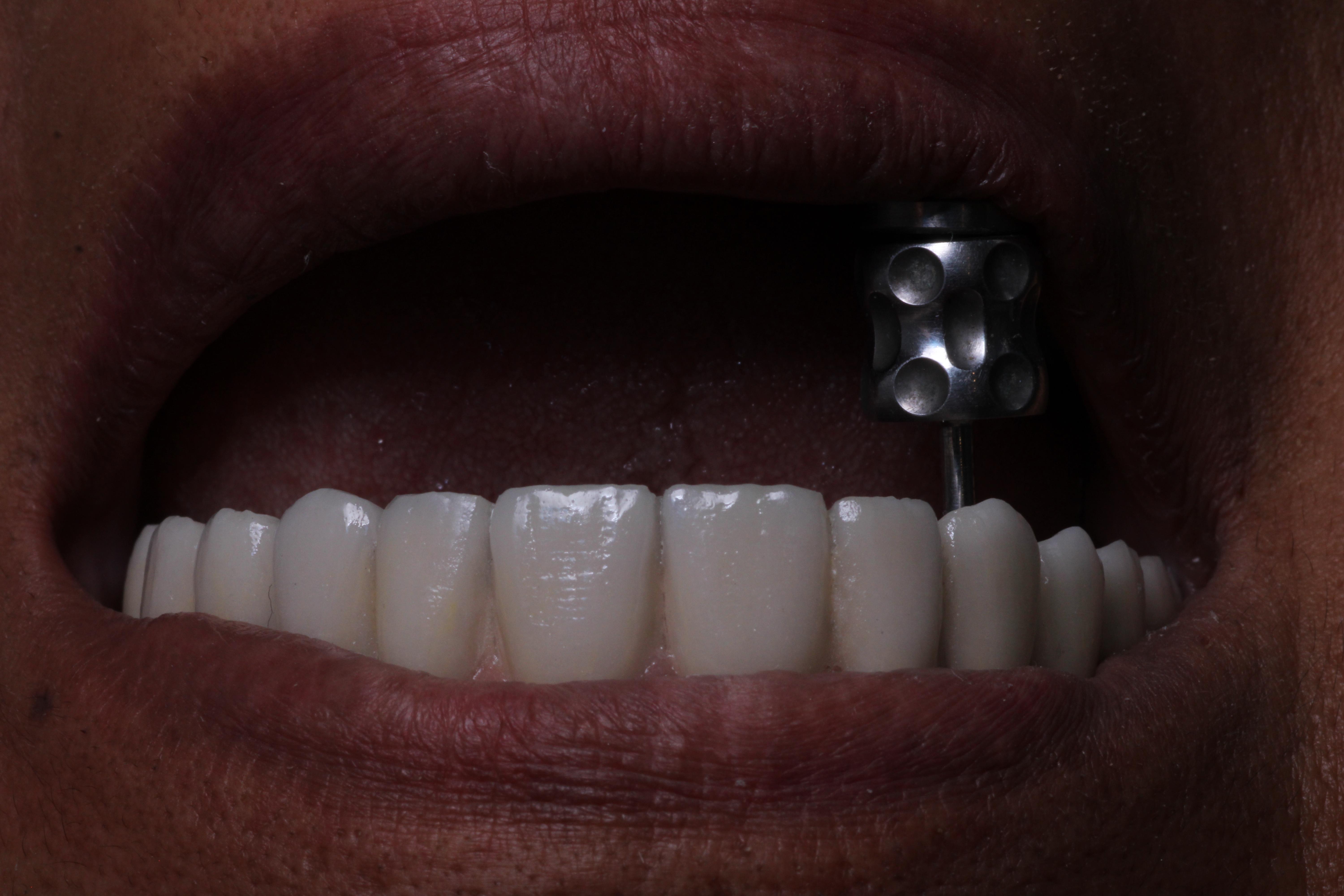 Comprobación del color de la corona dental con guía de tonalidades