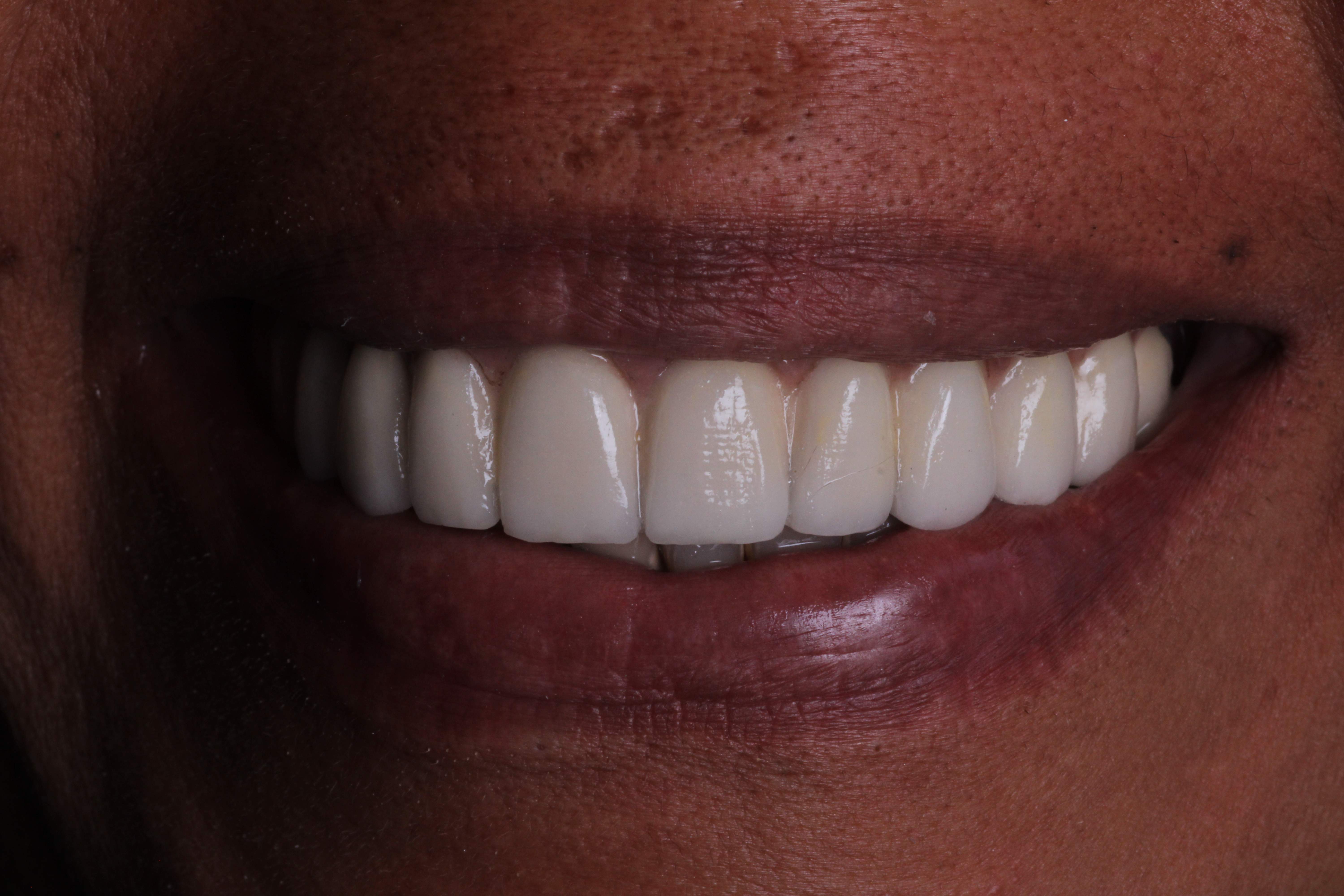 Resultado final: sonrisa completa con coronas sobre implantes de apariencia completamente natural