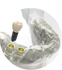 Guía quirúrgica para colocación precisa de implantes